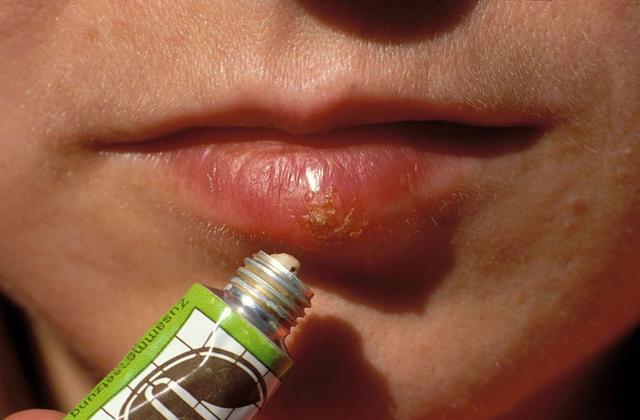 Übertragungsrisiko bei Herpes: Wann ist Ansteckung möglich?