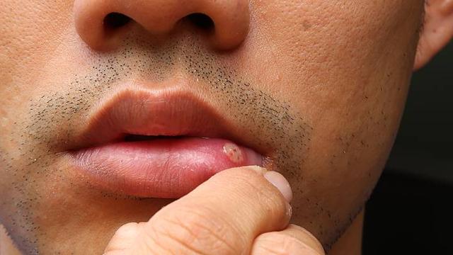Herpes-Übertragung: Zu welchen Zeitpunkten besteht Ansteckungsgefahr?
