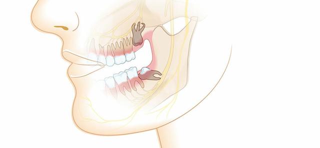 2. Probleme mit eingewachsenen Weisheitszähnen: Ursachen und Symptome