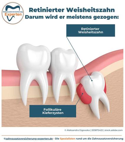 3. Vor und nach der Operation bei eingewachsenen Weisheitszähnen: Was ist zu beachten?