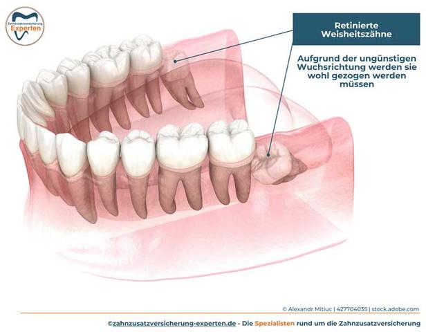 1. Wann kommen Weisheitszähne und wie verläuft ihr Wachstum?