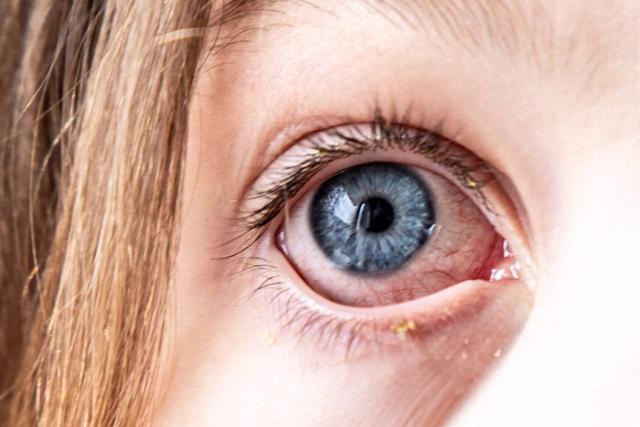 Nach einer Bindehautentzündung: Wann darf mein Kind wieder in die Kita? Nach einer Bindehautentzündung: Wann darf mein Kind wieder in die Kita?