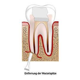Wiederherstellung der normalen Ernährung nach einer Wurzelspitzenresektion Wiederherstellung der normalen Ernährung nach einer Wurzelspitzenresektion