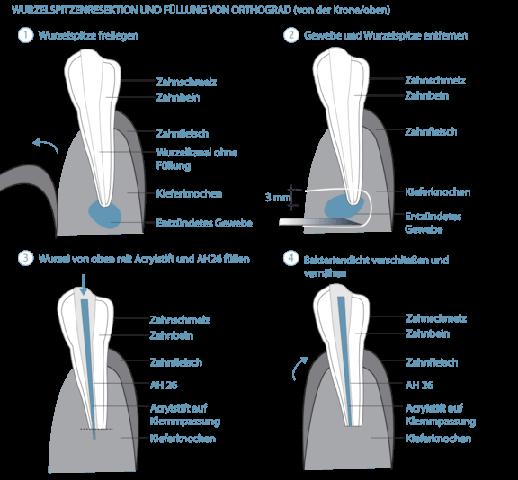 Ernährungsempfehlungen nach einer Wurzelspitzenresektion Ernährungsempfehlungen nach einer Wurzelspitzenresektion