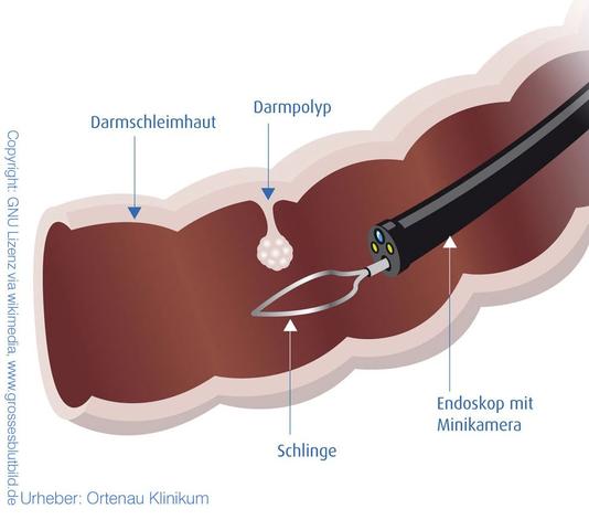 Wie man sicherstellt, dass der Darm vor einer Darmspiegelung gründlich gereinigt ist
