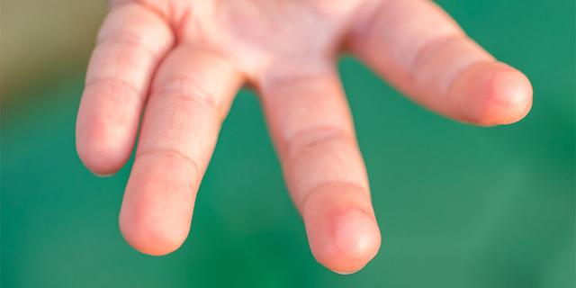 Was sind die Symptome, bei denen ein Arztbesuch bei einer Brandblase empfohlen wird? Was sind die Symptome, bei denen ein Arztbesuch bei einer Brandblase empfohlen wird?