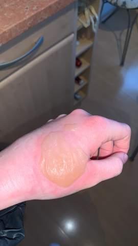 Wann sollte man mit einer Brandblase zum Arzt gehen? Wann sollte man mit einer Brandblase zum Arzt gehen?