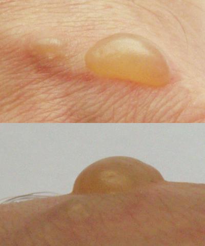 Wie erkennt man, wann eine Brandblase ärztliche Behandlung benötigt? Wie erkennt man, wann eine Brandblase ärztliche Behandlung benötigt?