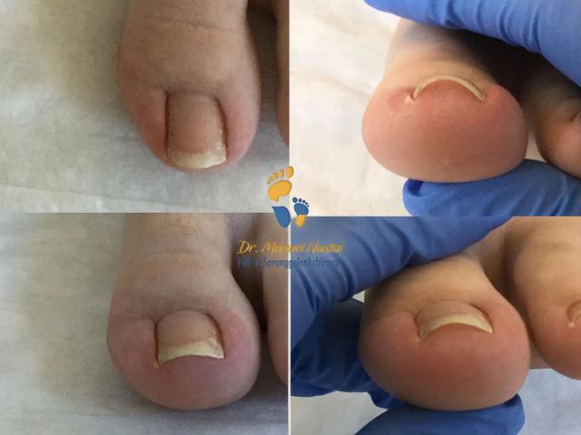 Warnsignale erkennen: Wann wird ein eingewachsener Zehennagel gefährlich? Warnsignale erkennen: Wann wird ein eingewachsener Zehennagel gefährlich?