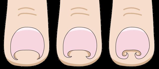 Wann wird ein eingewachsener Zehennagel gefährlich? Symptome und Risiken im Überblick Wann wird ein eingewachsener Zehennagel gefährlich? Symptome und Risiken im Überblick