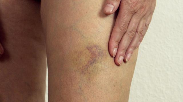 Bluterguss: Ab wann wird ein Hämatom gefährlich? Bluterguss: Ab wann wird ein Hämatom gefährlich?