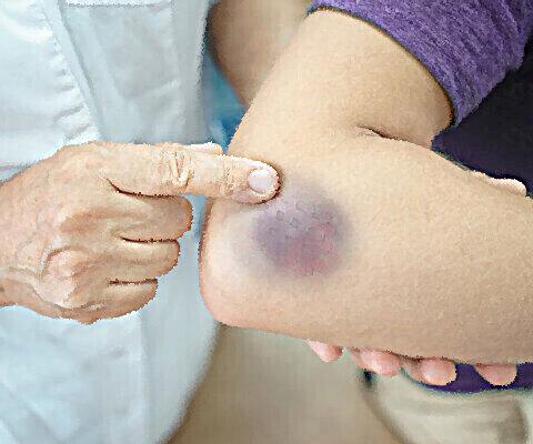 Hämatome: Wann sollte man ärztliche Hilfe suchen? Hämatome: Wann sollte man ärztliche Hilfe suchen?