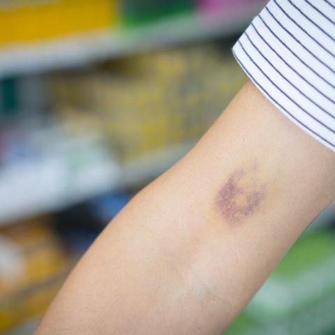 Blaue Flecken und Hämatome: Ab wann besteht Gefahr? Blaue Flecken und Hämatome: Ab wann besteht Gefahr?