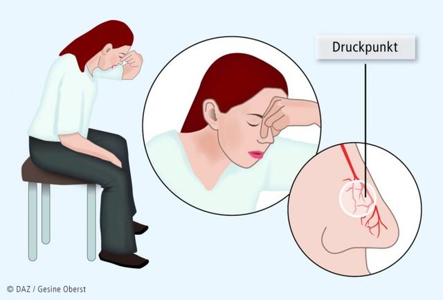 Wann ist Nasenbluten bedenklich? Symptome und Handlungsempfehlungen