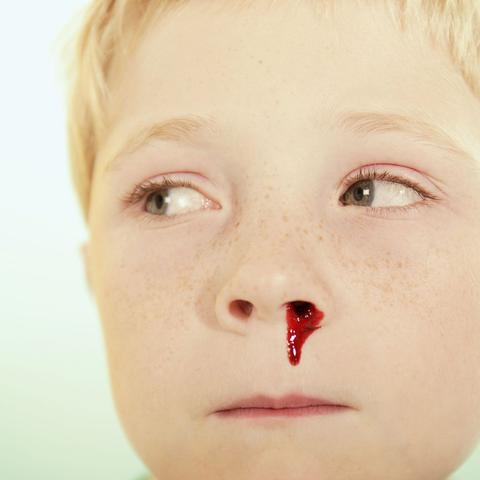 Nasenbluten: Ab wann sollte man zum Arzt gehen?