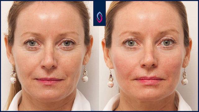 Ab wann ist die Wirkung von Botox sichtbar? Ab wann ist die Wirkung von Botox sichtbar?