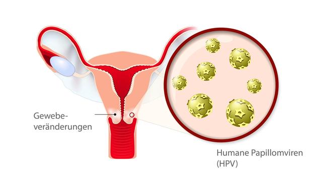 Angesteckt mit HPV: Wann wurde ich positiv getestet?
