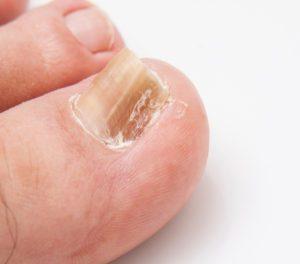 Bei einem Bluterguss unter dem Nagel: Wann ist ein Besuch beim Arzt ratsam? Bei einem Bluterguss unter dem Nagel: Wann ist ein Besuch beim Arzt ratsam?