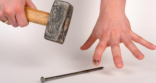 Bei einem Bluterguss unter dem Nagel: Wann ist ärztliche Hilfe erforderlich? Bei einem Bluterguss unter dem Nagel: Wann ist ärztliche Hilfe erforderlich?