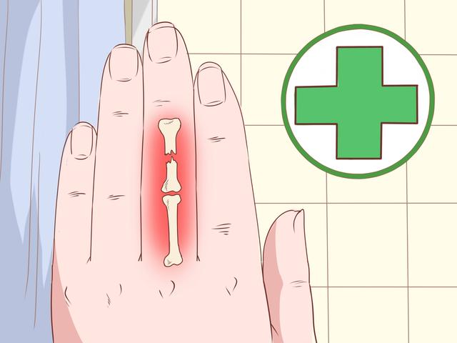 Wann sollte man bei einem eingeklemmten Finger einen Arzt aufsuchen? Wann sollte man bei einem eingeklemmten Finger einen Arzt aufsuchen?