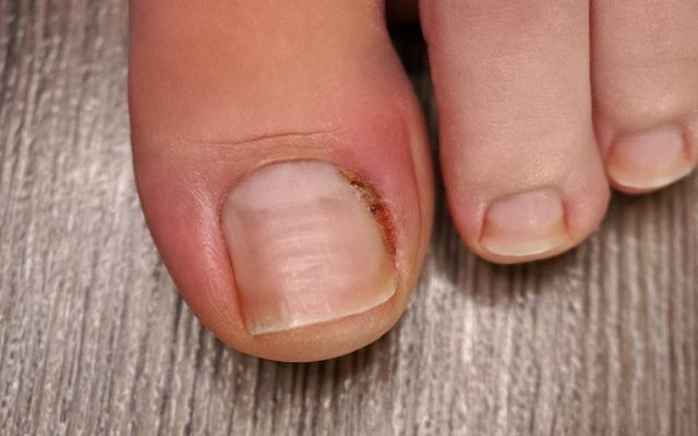Nagelbettentzündung: Wann ist ein Arztbesuch erforderlich? Nagelbettentzündung: Wann ist ein Arztbesuch erforderlich?