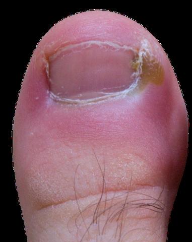 Nagelbettentzündung: Symptome und richtiger Zeitpunkt für einen Arztbesuch Nagelbettentzündung: Symptome und richtiger Zeitpunkt für einen Arztbesuch