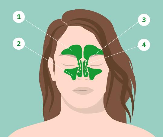 Symptome von Nasennebenhöhlenentzündung: Wann ist ein Arztbesuch erforderlich? Symptome von Nasennebenhöhlenentzündung: Wann ist ein Arztbesuch erforderlich?