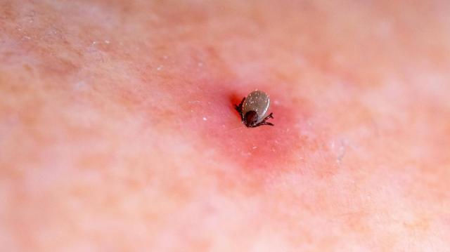 Bei welcher Art von Rötung nach einem Zeckenbiss sollte man einen Arzt konsultieren? Bei welcher Art von Rötung nach einem Zeckenbiss sollte man einen Arzt konsultieren?