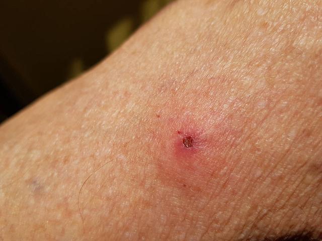 Zeckenstich-Folgen: Symptome erkennen und zum Arzt gehen Zeckenstich-Folgen: Symptome erkennen und zum Arzt gehen