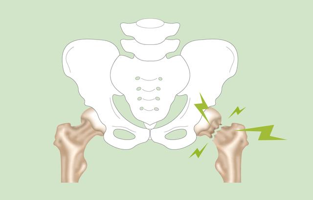 Warum sterben ältere Menschen häufig an einem Oberschenkelhalsbruch?
