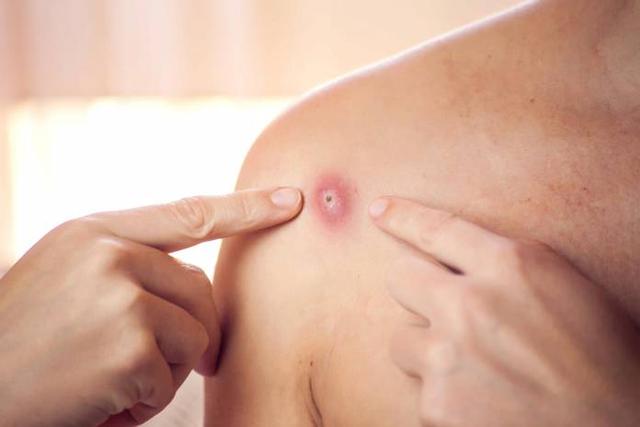 Warum ein Abszess ärztlich behandelt werden sollte Warum ein Abszess ärztlich behandelt werden sollte