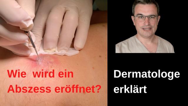 Die richtige Vorgehensweise bei der Behandlung eines Abszesses Die richtige Vorgehensweise bei der Behandlung eines Abszesses