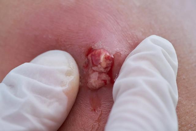 Symptome und Behandlungsmöglichkeiten bei einem Abszess Symptome und Behandlungsmöglichkeiten bei einem Abszess