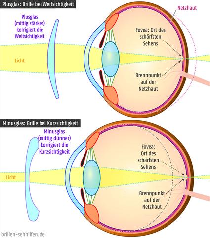 Kurzsichtig oder weitsichtig: Was ist der Unterschied und wie wirkt es sich aus? Kurzsichtig oder weitsichtig: Was ist der Unterschied und wie wirkt es sich aus?