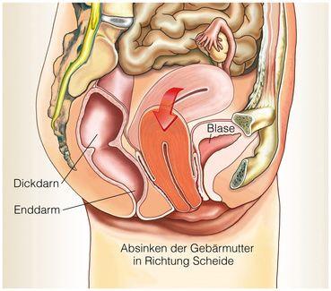 Gebärmuttersenkung: Symptome, Ursachen und Behandlungsmöglichkeiten Gebärmuttersenkung: Symptome, Ursachen und Behandlungsmöglichkeiten