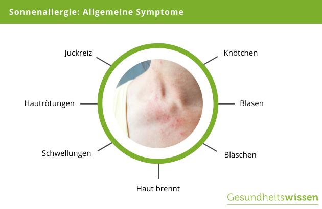 Expertentipps zur Linderung von Sonnenallergie-Symptomen