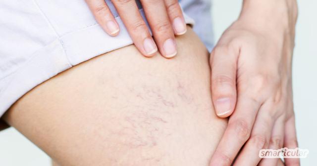 Was tun gegen Besenreiser? Tipps und Tricks zur Vorbeugung und Behandlung