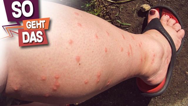 Schnelle Hilfe bei Mückenstichen: Tipps und Tricks