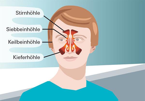 Hausmittel und Medikamente bei Sinusitis Hausmittel und Medikamente bei Sinusitis