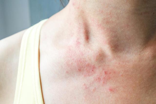 Sonnenallergie-Ausschlag bekämpfen: Die besten Maßnahmen und Hausmittel Sonnenallergie-Ausschlag bekämpfen: Die besten Maßnahmen und Hausmittel