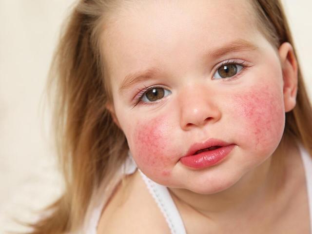 Vorbeugung und Behandlung von Sonnenallergie-Ausschlag: Was wirklich hilft Vorbeugung und Behandlung von Sonnenallergie-Ausschlag: Was wirklich hilft