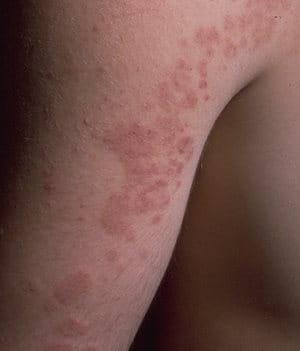 Symptome einer Sonnenallergie: Was hilft gegen juckenden Ausschlag? Symptome einer Sonnenallergie: Was hilft gegen juckenden Ausschlag?