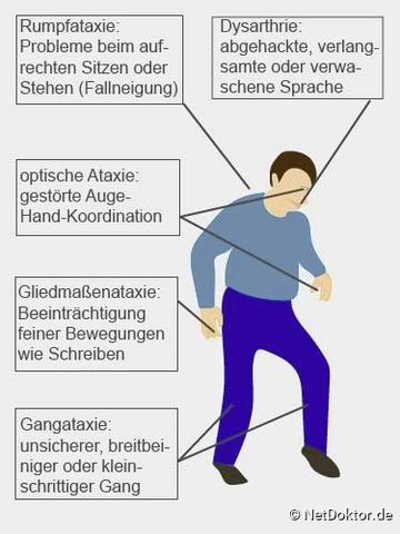Ursachen und Symptome von Ataxie: Eine umfassende Übersicht Ursachen und Symptome von Ataxie: Eine umfassende Übersicht