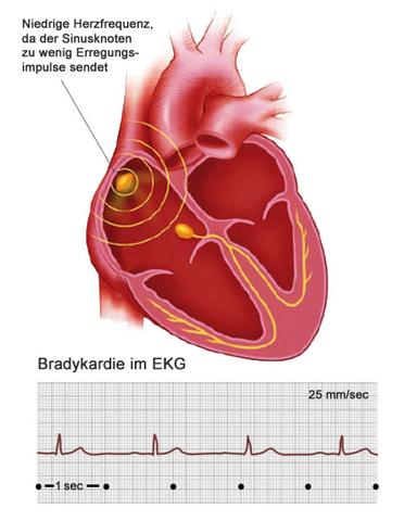 Bradykardie verstehen: Ursachen, Risiken und Behandlungsmöglichkeiten