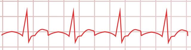 Die Bedeutung von MRT-Untersuchungen für Patienten mit Herzschrittmacher bei Bradykardie
