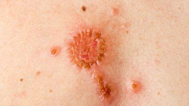 Nachbehandlung nach der Behandlung eines Basalzellkarzinoms Nachbehandlung nach der Behandlung eines Basalzellkarzinoms