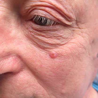 Was ist ein Basaliom und wie sieht es aus? Was ist ein Basaliom und wie sieht es aus?