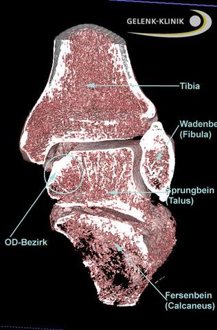 Digitale Volumentomographie (DVT) zur Diagnostik und OP-Planung bei Ermüdungsbruch