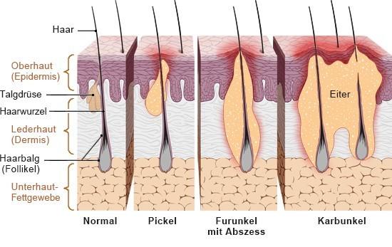 Furunkel: Symptome, Risikofaktoren und mögliche Komplikationen