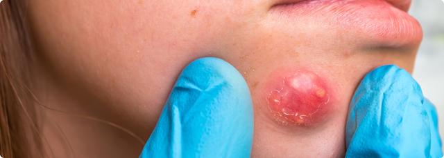 Weitere Informationen zu Furunkeln: Ursachen, Behandlungsmöglichkeiten und Vorbeugung